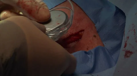 Insertion of a Pacemaker, Close Up (With Audio) Stock Footage 33987466