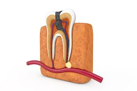Inside of Decay Tooth. 3d Rendering Stock Illustration
