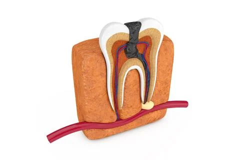 Inside of Decay Tooth. 3d Rendering Stock Illustration