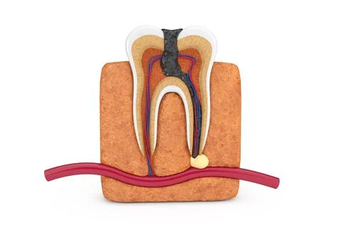 Inside of Decay Tooth. 3d Rendering Stock Illustration
