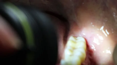 Inside the mouth after removing stitches after wisdom tooth extraction Stock Footage 325686846