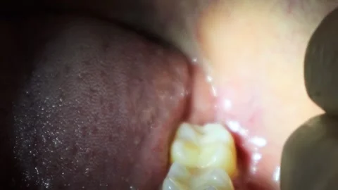 Inside the mouth after removing stitches after wisdom tooth extraction Stock Footage 325687966