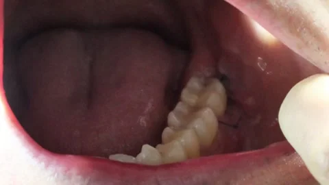 Inside the mouth after wisdom teeth extraction Stock Footage 325687133