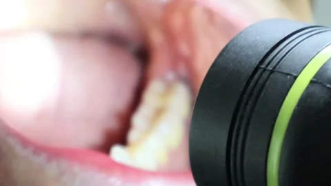 Inside the mouth after wisdom teeth extraction Stock Footage 325687162