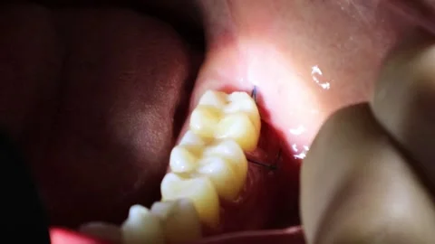Inside the mouth after wisdom teeth extraction 스톡 동영상 325687197