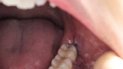 Inside the mouth after wisdom teeth extraction Stock Footage 325687205