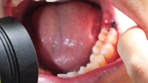 Inside the mouth immediately after wisdom tooth extraction Video stock 325687843