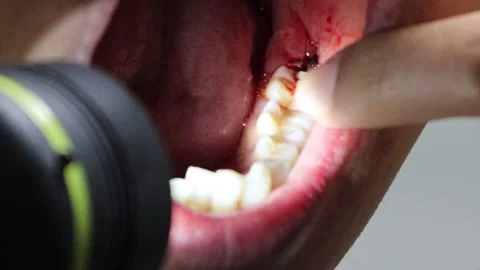 Inside the mouth immediately after wisdom tooth extraction 스톡 동영상 325687899