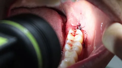 Inside the mouth immediately after wisdom tooth extraction Stock Footage 325687902