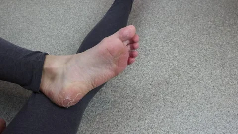 Inspecting large blisters on the bottom of the foot, leg calluses Stock Footage 287130472