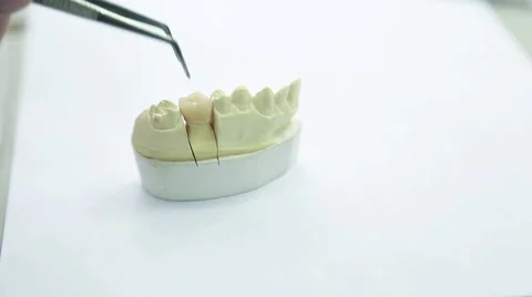 Inspection artificial crown to girth of neck of tooth, closeup Stock Footage 66952428