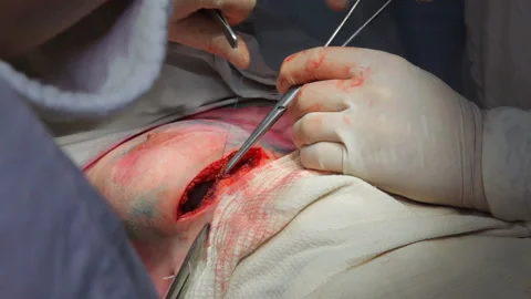 Installation of a breast implant after removal of a cancerous tumor. Stock Footage 88204853