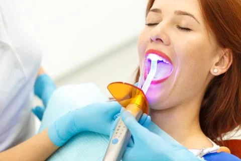 Installation of light-curing fillings Stock Photos