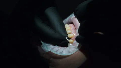 Installation of veneers on the jaw closeup Stock Footage 112130991