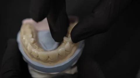 Installation of veneers on the jaw Stock Footage 152516485