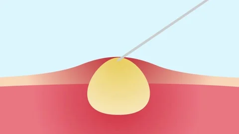 Instruction of how to cure an acne and pimples in hospital / graphic animation Stock Footage 133119732
