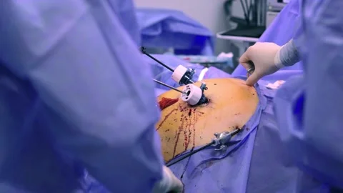 Instrument for laparoscopic surgery. Stockbeeldmateriaal 270554929