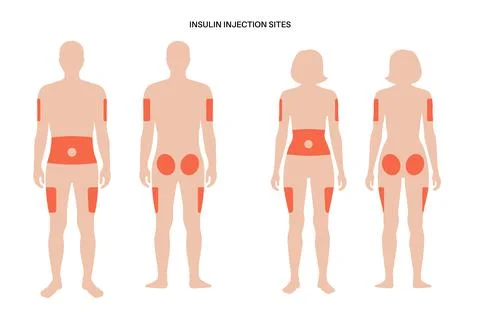 Insulin injection sites Stock Illustration