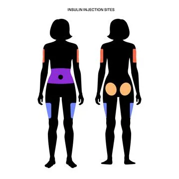 Insulin injection sites Illustrazione stock