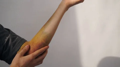 Intense bruising from a dislocated elbow joint and ligament damage on man. The Video stock 128174152