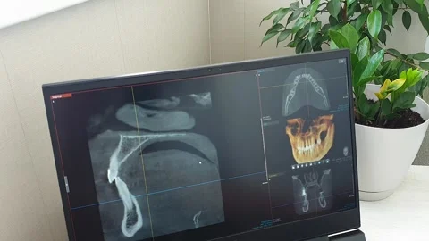 Interactive 3D Dental CBCT Software Interface Showing Jawbone Volume Render.. Stock Footage 341286296