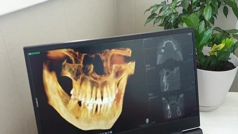 Interactive 3D Dental CBCT Software Interface Showing Jawbone Volume Render.. Stock Footage 341286569