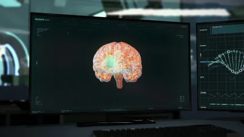 Interface of the diagnostic software detecting deadly brain tumor in a patient Stock Footage 168859979