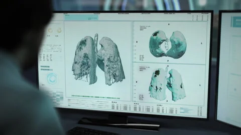 Interface of a hospital system scanning the lungs to find cancer treatment Vídeo Stock 271584709