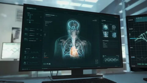 Interface of the medical analysis scanner software identifying the brain tumor Stock Footage