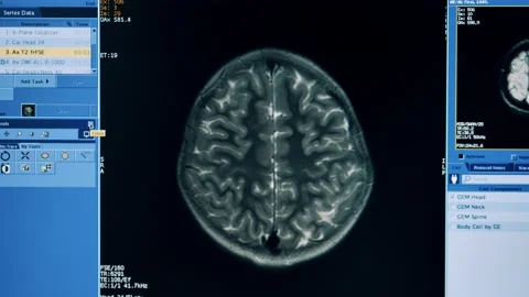 Interface of an MRI computer program during head scanning Video stock 145831423