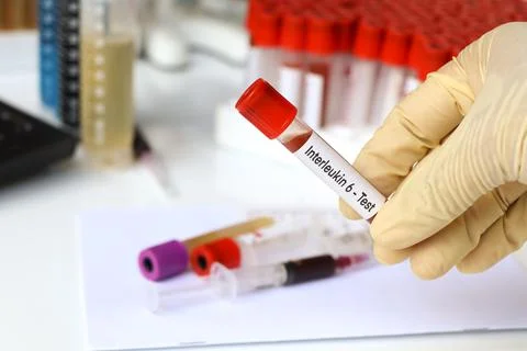 Interleukin 6 test to look for abnormalities from blood Stock Photos