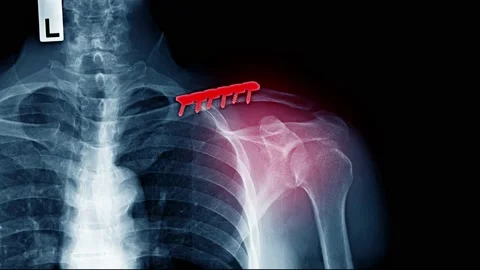 Internal fixation of clavicle Video stock 148598714