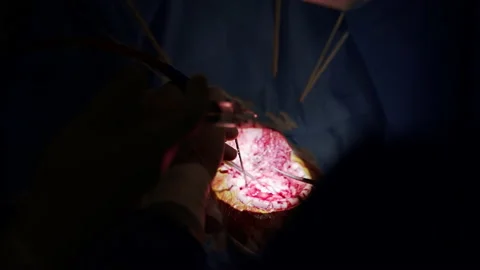 Internal organ during surgery in darkness. Hands of a doctor with surgical tools Stock Footage 139197346