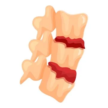 Intervertebral disc herniating, showing spinal cord damage Stock Illustration