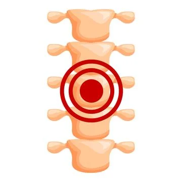 Intervertebral disc herniation causing back pain Stock Illustration