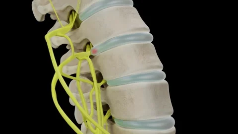 Intervertebral disc prolapse Stock Footage 263441722