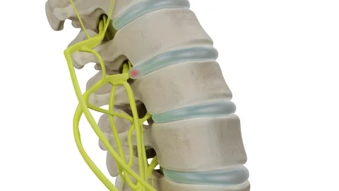 Intervertebral disc prolapse white Stock Footage 263244027
