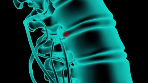 Intervertebral disc prolapse xray Stock Footage 263347552