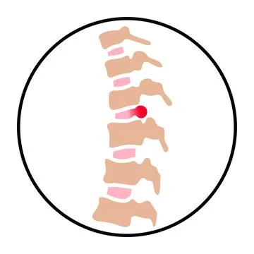 Intervertebral hernia concept Stock Illustration