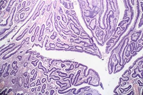 Intestinal adenomas, light micrograph Stock Photos