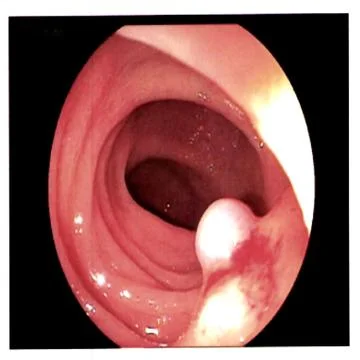 Intestinal polyps. 3D rendering. Polyps are a growth of tissue occurring on t Stock Photos