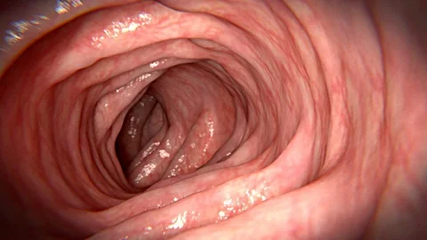 Intestinal polyps growing Vidéo 113235298