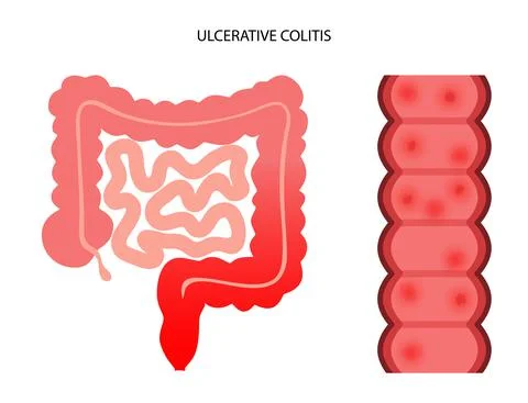 Intestine ulcerative colitis Stock Illustration