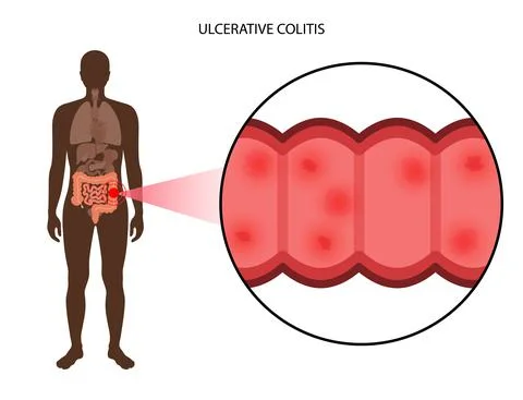 Intestine ulcerative colitis Stock Illustration