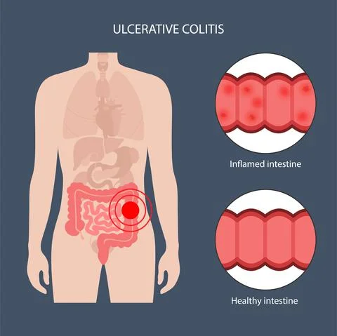 Intestine ulcerative colitis Stock Illustration