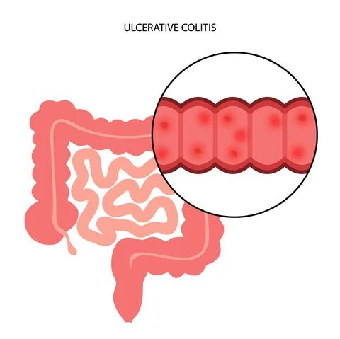 Intestine ulcerative colitis Illustrazione stock