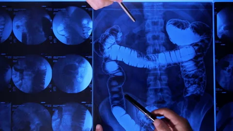 Intestine X-ray  Stock-Footage 194827147