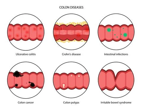 Intestines diseases concept Stock-Illustration