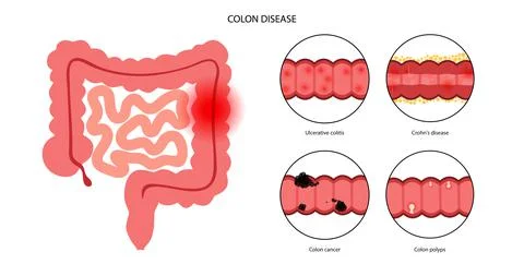 Intestines diseases concept Stock-Illustration