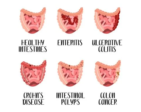 Intestines diseases. Enteritis, ulcerative colitis, Crohn's disease, polyp, c Stock Illustration